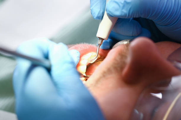 Best Emergency Tooth Extraction in St Michael, MN